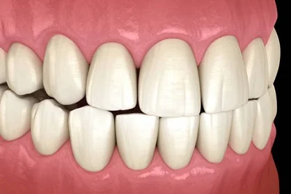 Bulky Teeth
