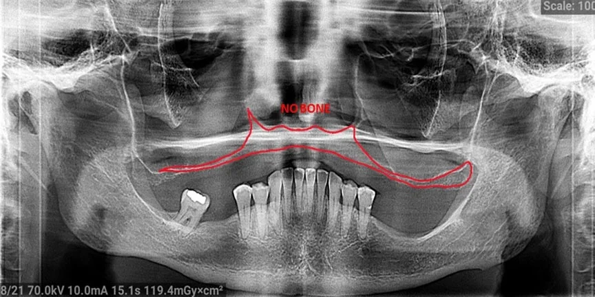 Panoramic dental X-ray showing jawbone structure with red highlight indicating surgical area.