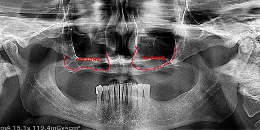 Panoramic dental X-ray showing jaw structure with red highlighted areas indicating implant planning or assessment.