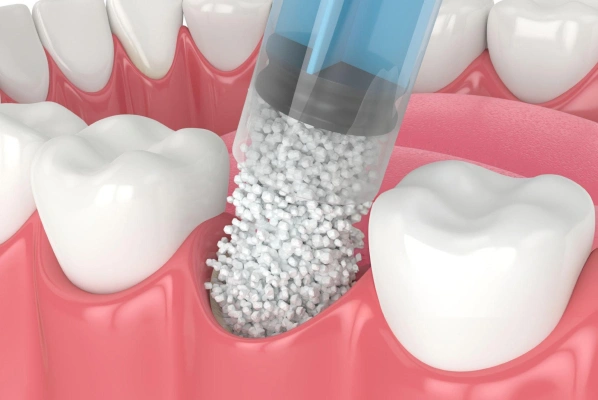 bone grafting in Little rock
