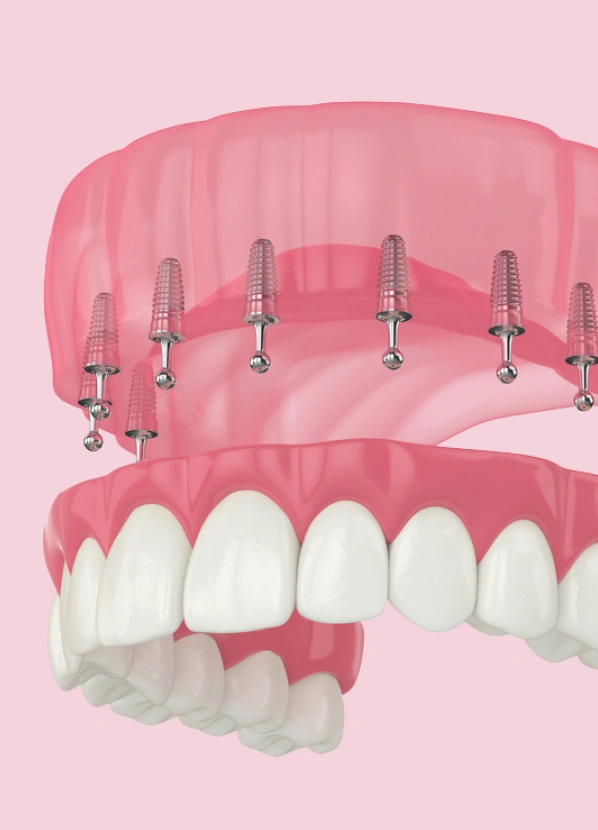 Snap-In Implant Dentures