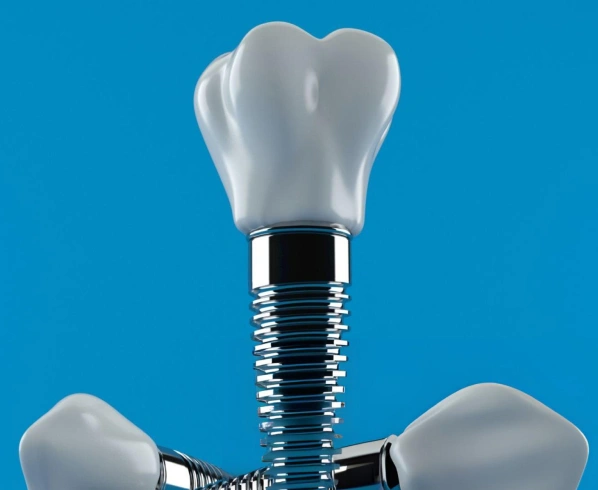 Cost of Dental Implants